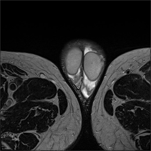 MRI of the lesion.