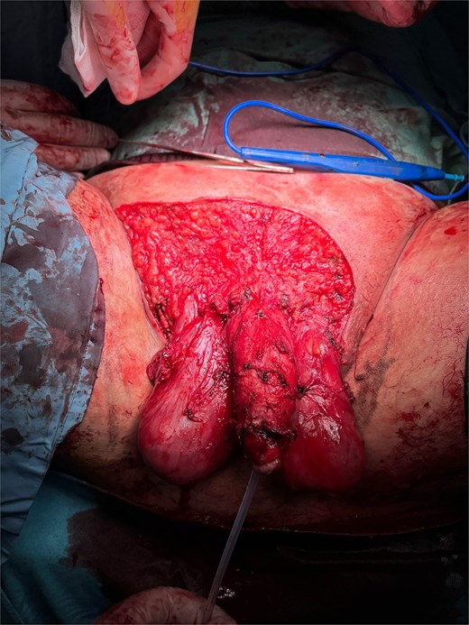 Intraoperative image showing the entity of the excision.