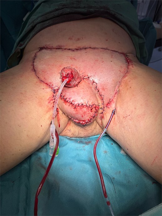 Immediate postoperative result.