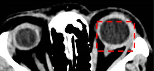 Computed tomography brain and orbits with contrast. Axial image demonstrating posterior scleritis in the left eye (dashed box).