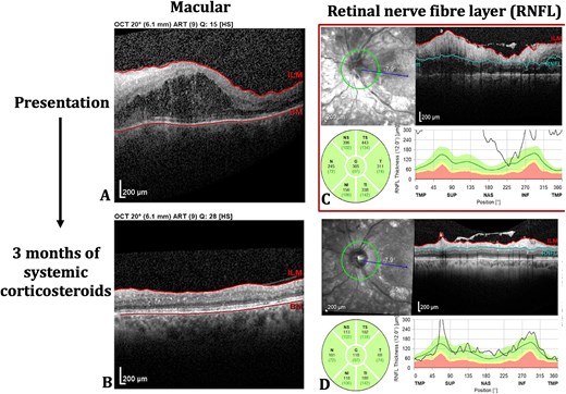 Left eye optical coherence tomography (OCT) scans of macular (A, B) and retinal nerve fibre flayer (RNFL) (C, D) at both presentation and following 3 months of systemic corticosteroids.