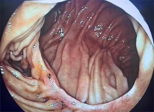 Contrast-enhanced abdominal CT demonstrating compression of the third portion of the duodenum: (A) axial view showing duodenal dilatation and abrupt narrowing; (B) sagittal reconstruction revealing a reduced aortomesenteric angle of 17°.
