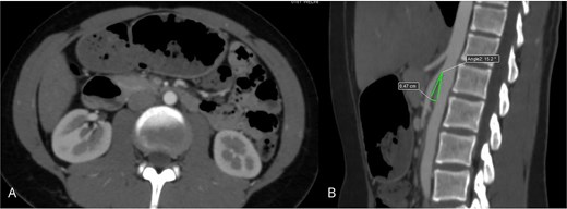 Intraoperative laparoscopic view showing the creation of a side-to-side duodenojejunal anastomosis using a 45-mm linear stapler.