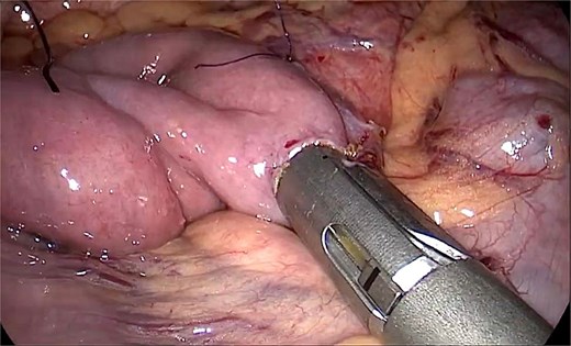 Upper gastrointestinal endoscopy performed one year after surgery demonstrating a widely patent and well-healed duodenojejunal anastomosis without stricture, ulceration, or stasis.