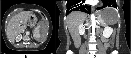(a) Axial and (b) coronal contrast-enhanced CT images demonstrating a peri-splenic hematoma measuring 8.6 × 10.2 cm with associated hemoperitoneum.