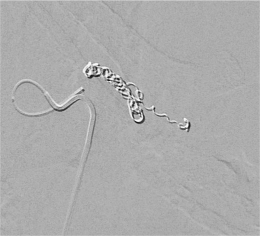 Digital subtraction angiography image demonstrating selective splenic artery microcoil embolization used to control hemorrhage while preserving collateral perfusion.