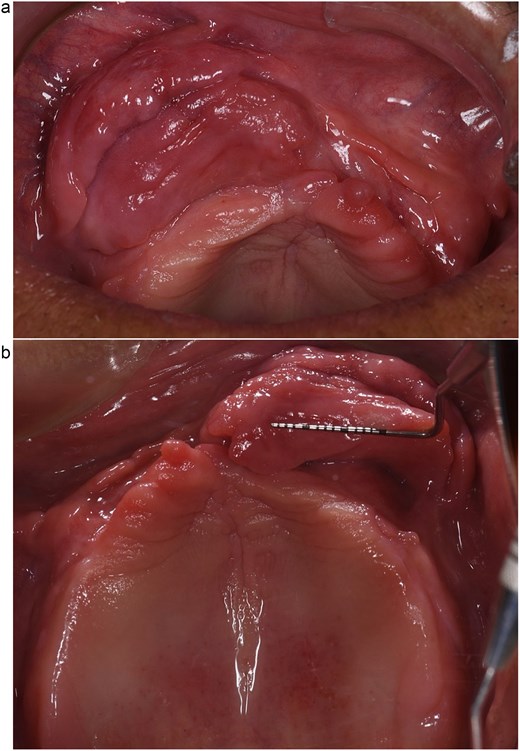 Clinical image of multiple folds with a firm, fibrous, smooth appearance and no signs of active ulceration. (a) Front view. (b) Occlusal view.