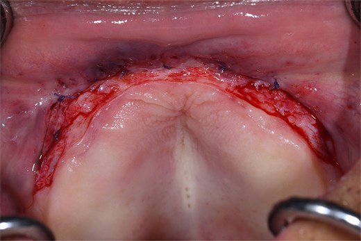 Intraoperative view of the anterior vestibular area during the first surgical procedure, after complete removal of the epulis fissuratum. The surgical bed is identified with defined margins, correct control of hemostasis, and preservation of adjacent healthy tissue.