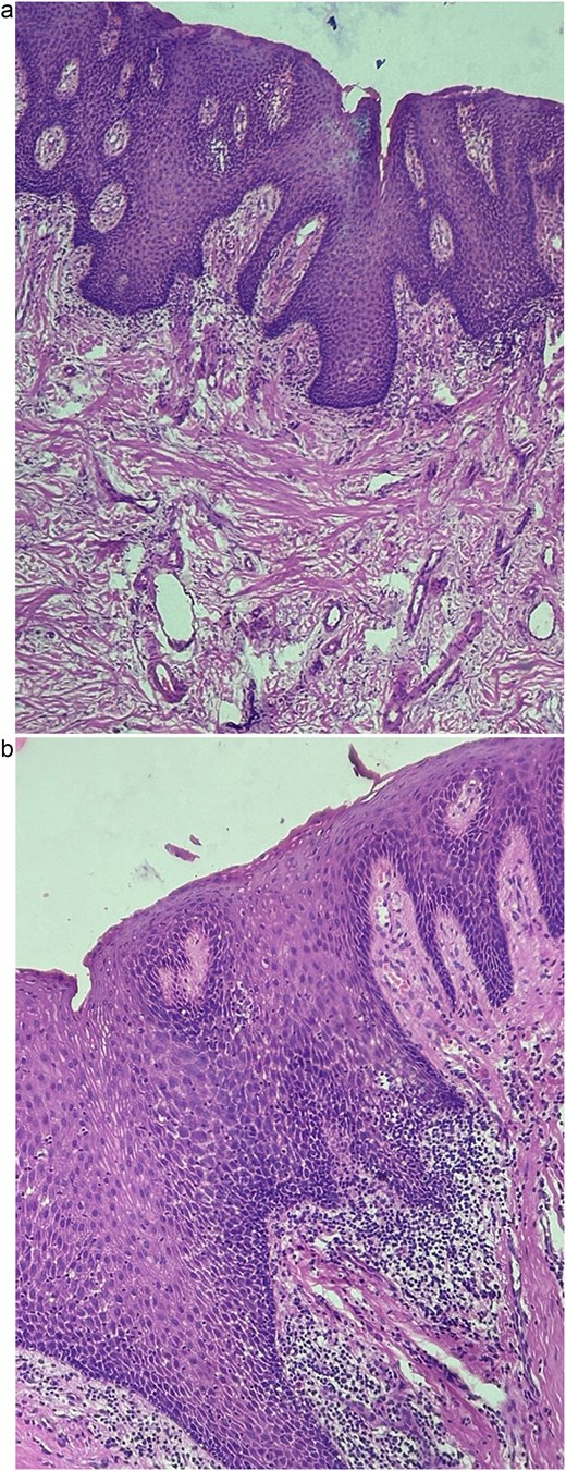 (a, b) Mucosa with acanthosis of the non-keratinizing stratified squamous epithelium with mixed inflammatory infiltrate.