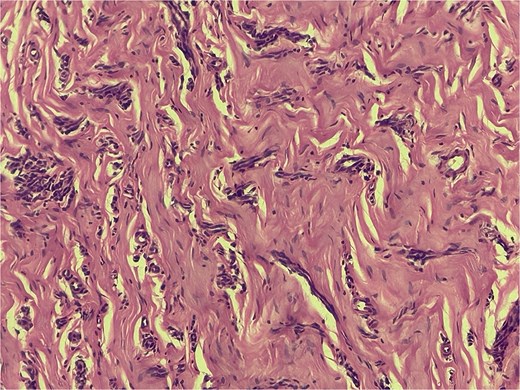 Hypertrophy of collagen fibers on the lamina propria, with intertwining between them. Blood capillaries are observed to be collapsed with scattered chronic inflammatory infiltrate.