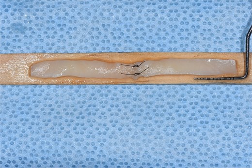 Free gingival graft measuring ~48 × 5 mm taken from the palatal area, presented on a sterile wooden board for handling, prior to adaptation and stabilization in the recipient site.