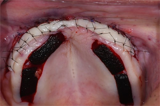 Free gingival graft placed in the anterior vestibular area and stabilized with 6–0 nylon, using the interrupted single stitch technique. The donor site was protected with a collagen sponge to promote hemostasis.