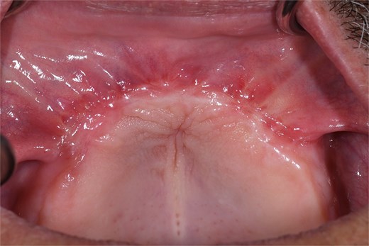 Clinical evolution three months after the second procedure, showing adequate healing, total integration of the gingival graft, and development of a stable keratinized gingival band.
