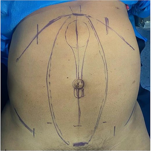 Preoperative skin marking of the surgical area, delineating the rectus diastasis and the associated epigastric and umbilical hernia defects.