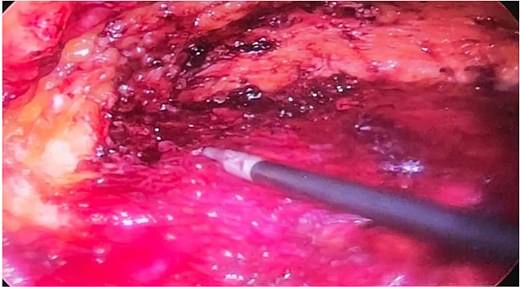 Laparoscopic dissection of the preaponeurotic space.