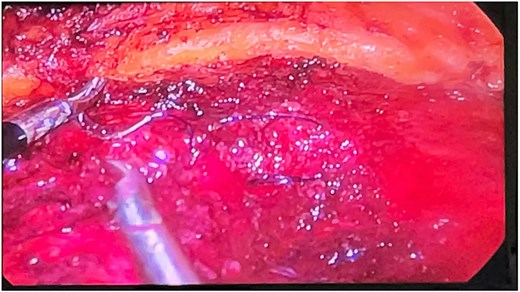 Intraoperative laparoscopic view showing the reduction of the hernia sacs and reconstruction of the linea alba using barbed running sutures.