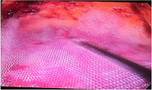 Placement of polypropylene mesh during laparoscopic REPA.
