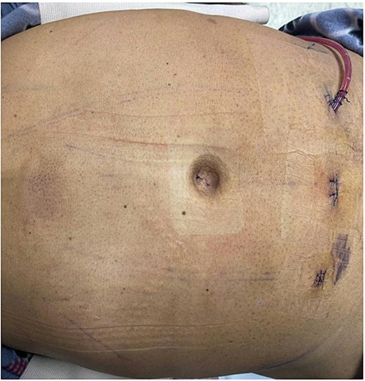 Immediate postoperative image showing a Penrose drain placed in the preaponeurotic space, which was removed on postoperative Day 7.