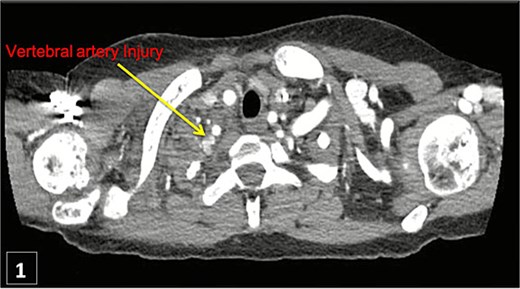 Thoracic CT angiogram shows contrast extravasation from left vertebral artery after CVC.