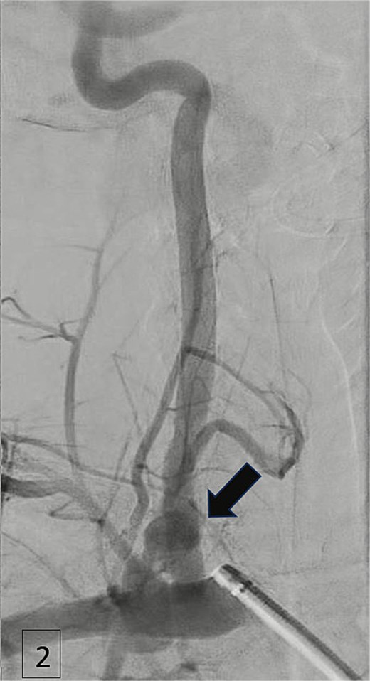 Angiogram demonstrating arterial injury following catheter insertion (arrow).