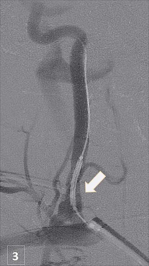 Post-stent angiogram showing complete sealing of injury with preserved flow.