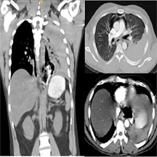 Contrast-enhanced chest CT showing distal esophageal perforation with pneumomediastinum and left hydropneumothorax.