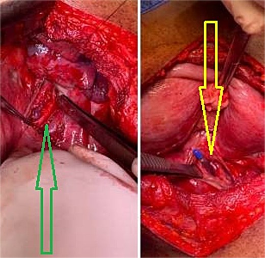Intraoperative image demonstrating esophageal perforation (right image), and mucosal repair (left image).