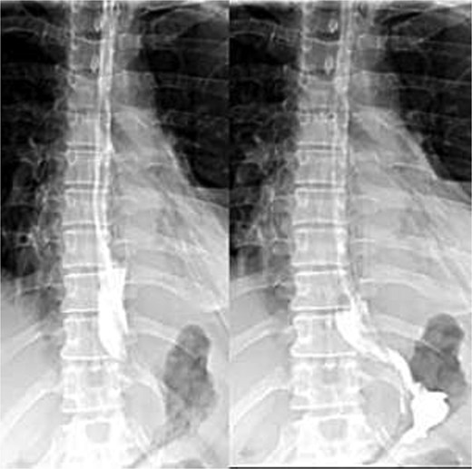 Postoperative Gastrografin esophagogram on day 5 showing free contrast flow without leakage.