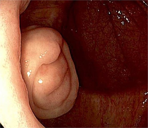 Colonoscopic image of protruding, intraluminal, “fish mouth” appearing mass at the appendiceal orifice.