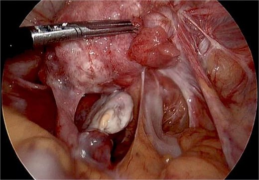 Intraoperative image of pelvic adhesions secondary to endometriosis. No mucin was seen.