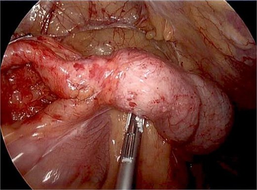 Intraoperative image of thickened caecum without any obvious mass on the serosal surface of colon and shortened appendix.