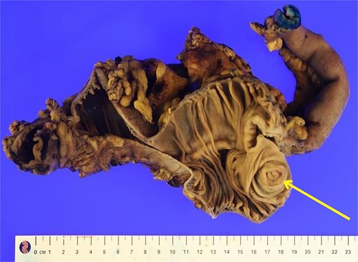 Transected ileocolic resection specimen with intraluminal view, arrow indicating appendiceal nodule.