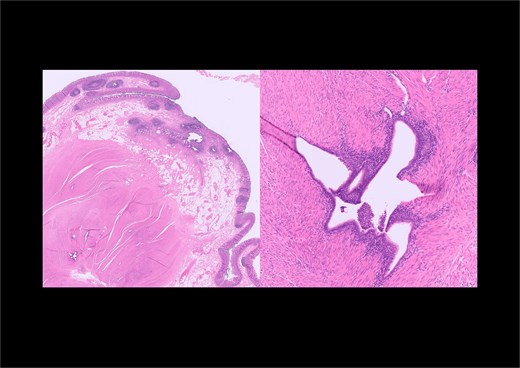 Low and high-power microscopic views of the appendix showing foci of endometriosis within the muscularis propria.