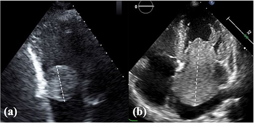 TTE findings. (a) Right atrial tumor and (b) left atrial tumor. Tumor size was assessed using the longest diameter measured by TTE. TTE, transthoracic echocardiography.