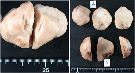 Biphasic synovial sarcoma. Grossly, the tumor appeared as a potato-like mass. The cut surface was slightly mucoid and whitish translucent, and the resection margin showed a finely granular appearance.