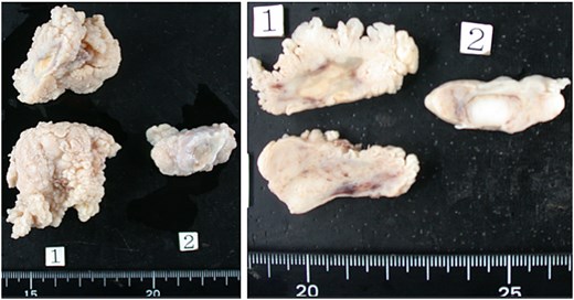 Intimal sarcoma. Grossly, the tumor was a large, cauliflower-like mass with partially cystic areas. It appeared milky white and showed no mucinous features.