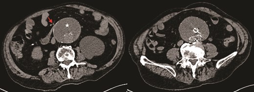 Axial CT image demonstrating obstruction of the duodenum at D3 between the aortic sac (star) and superior mesenteric artery (SMA) (arrow).