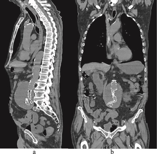 (a) Sagittal delayed multiphase CT image showing no endoleak. (b) Coronal CT image demonstrating EVAR and an aortic sac.