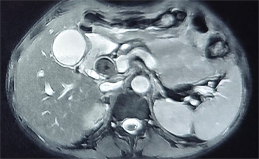 Magnetic resonance cholangiopancreatography (MRCP) confirmed cholelithiasis, acute cholecystitis, choledocholithiasis, and dilated CBD (3 cm) with central IHBRD with no suspicion of biliary stent.
