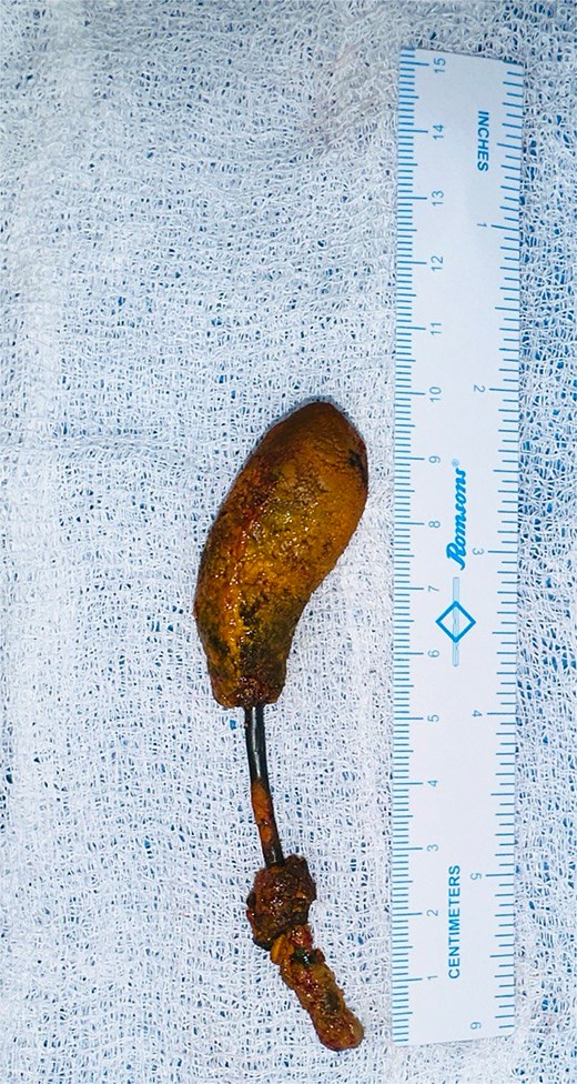 CBD exploration revealed stones embedded at the proximal and distal ends of the CBD stent, forming a dumbbell-shaped stent–stone complex.