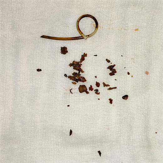 The friable stent–stone complex was removed in a piecemeal fashion.