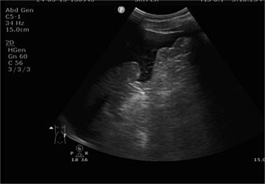 FAST demonstrated massive hemoperitoneum.