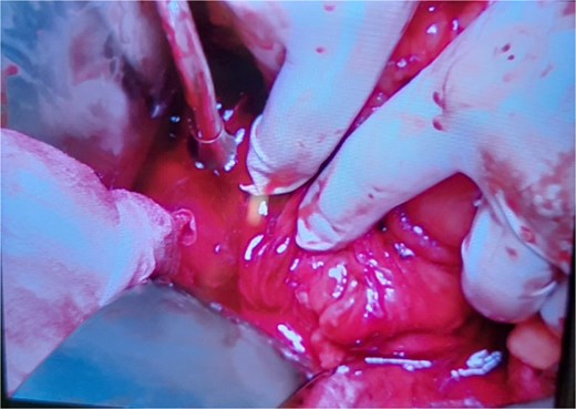 Disruption of second and third portion of duodenum.