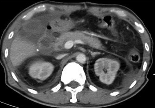 CT scan showed no active bleeding or pancreatic parenchymal/ductal injury.