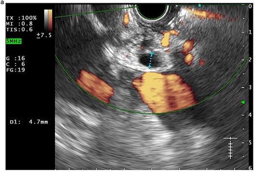 The CBD measured 4.7 mm on EUS from the duodenal bulb.