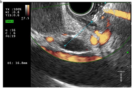Doppler confirmed no intervening vessels.