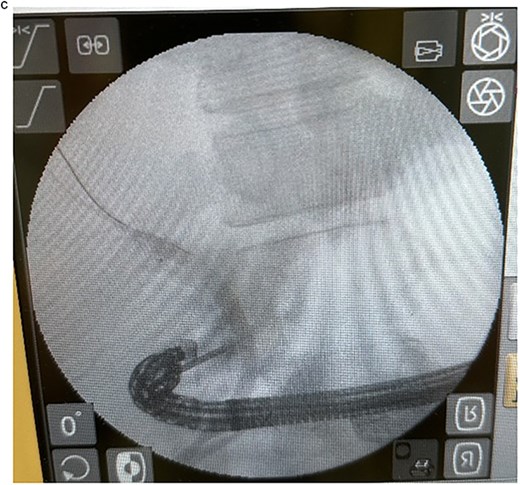 EUS-CDS under fluoroscopic guidance.