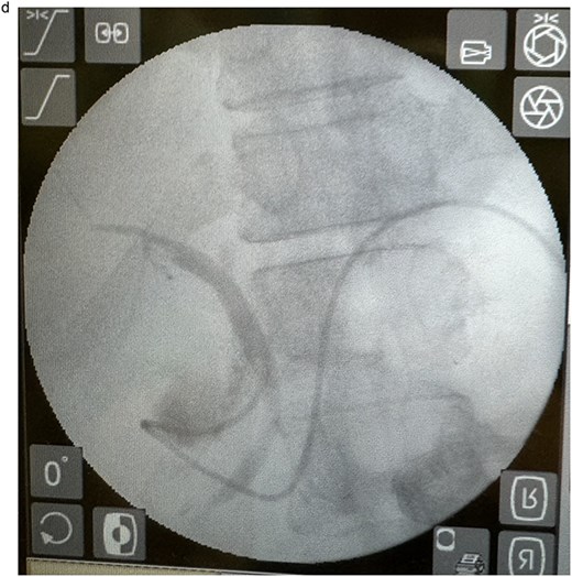EUS-CDS with ENBD under fluoroscopic guidance.