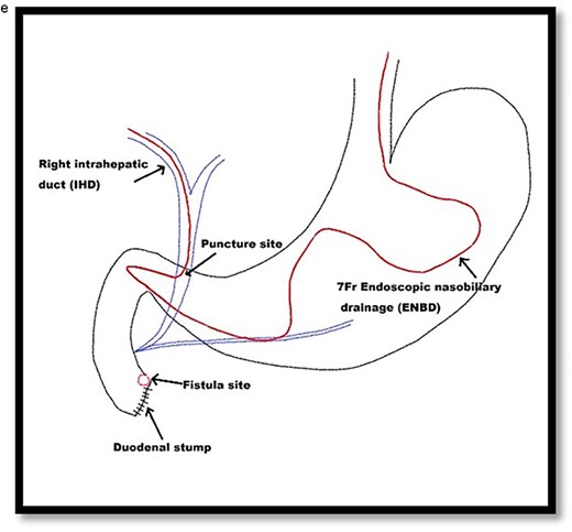 Schematic illustration of EUS-CDS with placement of a 7-Fr ENBD catheter into the right intrahepatic duct.