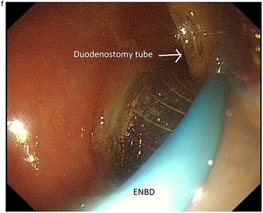 Endoscopic image demonstrating the 7-Fr ENBD catheter, with concurrent visualization of the duodenostomy tube at the proximal duodenal stump.